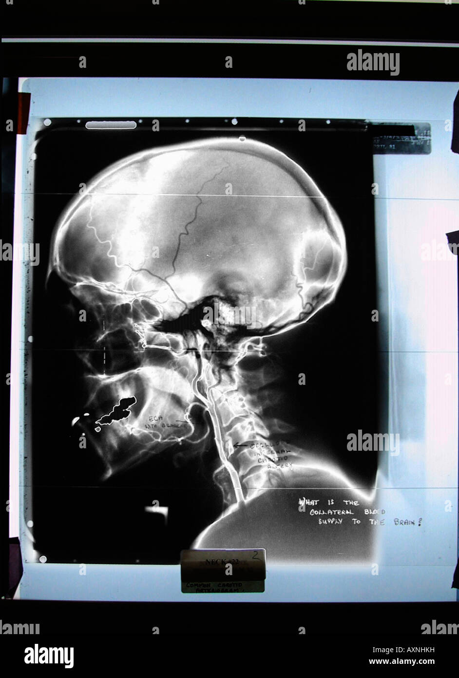 x ray of scull and neck Stock Photo