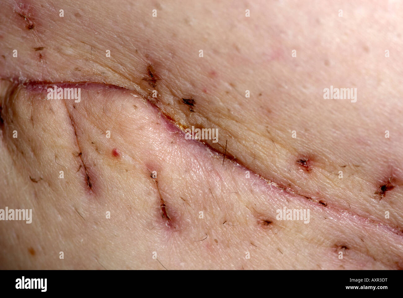 Scar on left inner thigh from operation to remove a high grade