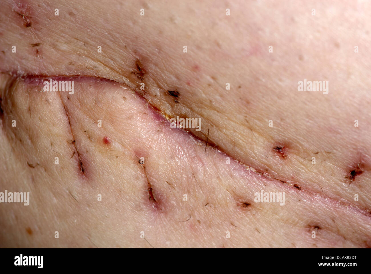 Leg Stitches Stock Photos Leg Stitches Stock Images Alamy