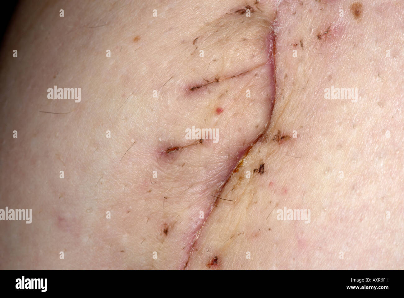 Stitches removed hi-res stock photography and images - Alamy