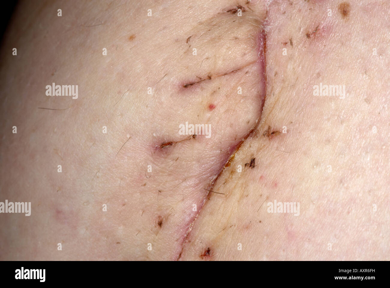 Leg Stitches Stock Photos Leg Stitches Stock Images Alamy