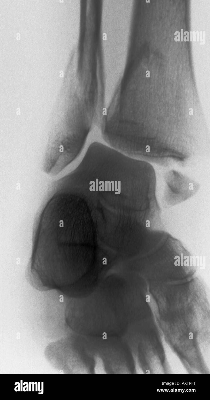 x-ray of a bimalleolar ankle fracture showing breaks in both the distal ...