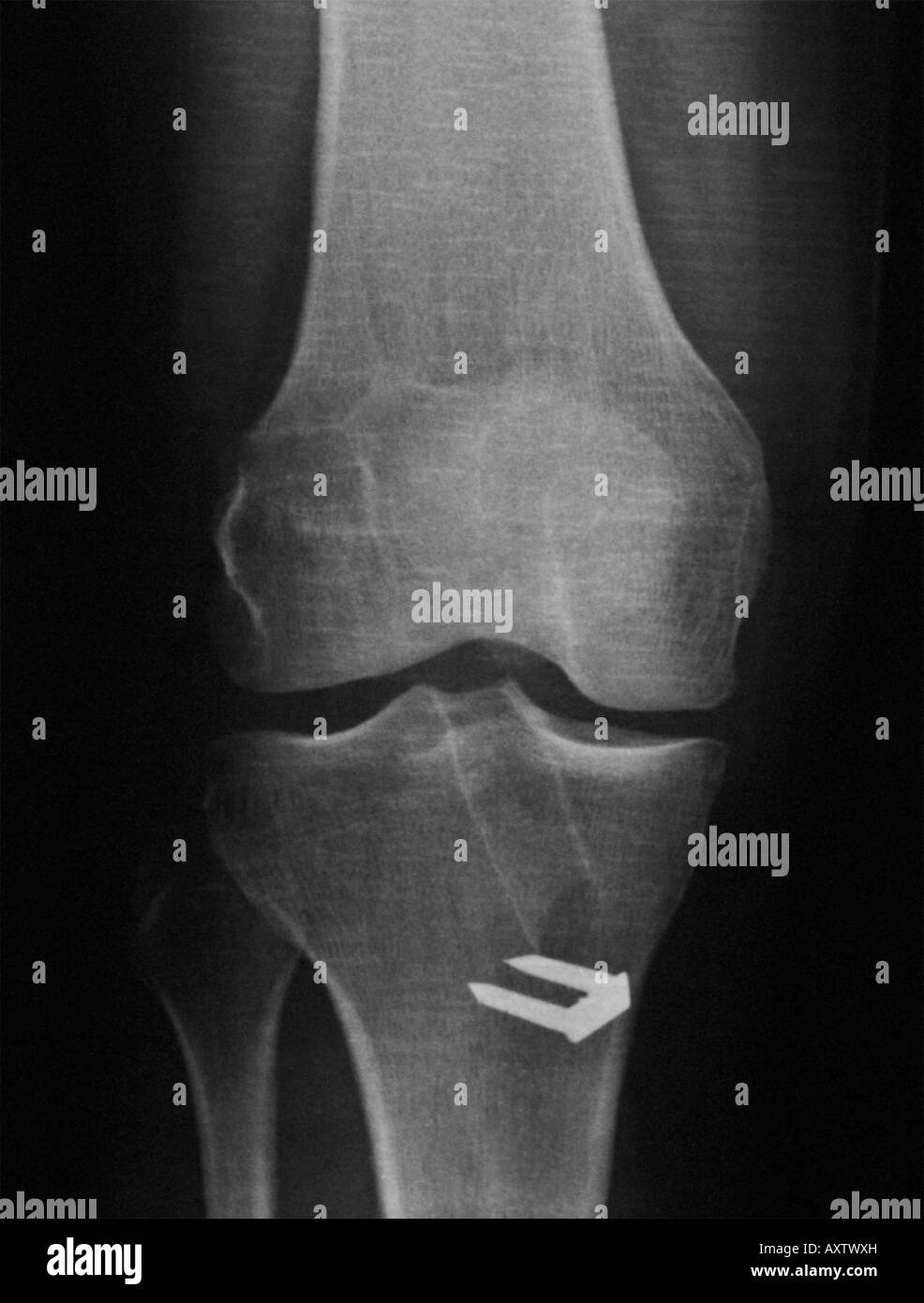 x-ray of the knee of a man who had surgery to repair a ruptured anterior cruciate ligament. Stock Photo