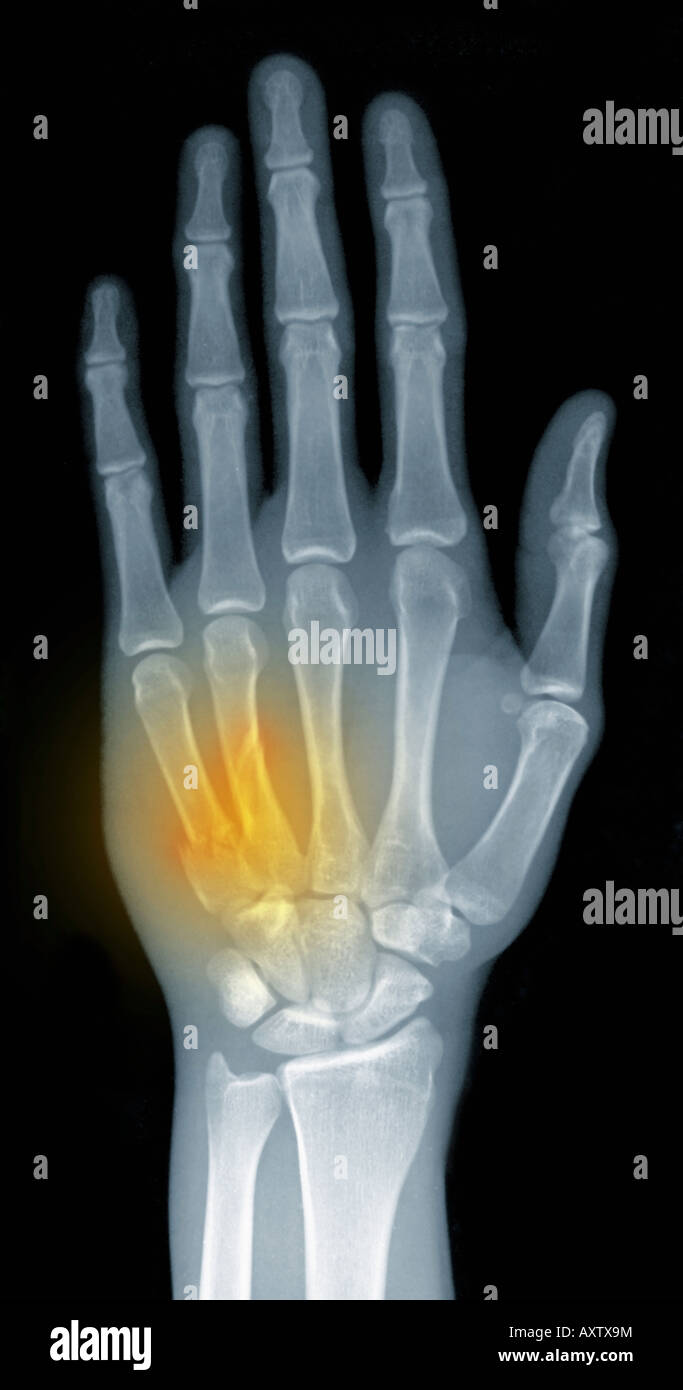 x-ray showing a fractured hand of a 22 year old man Stock Photo