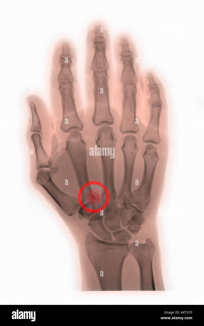 xray of the hand of a man with a fracture of the first metacarpal