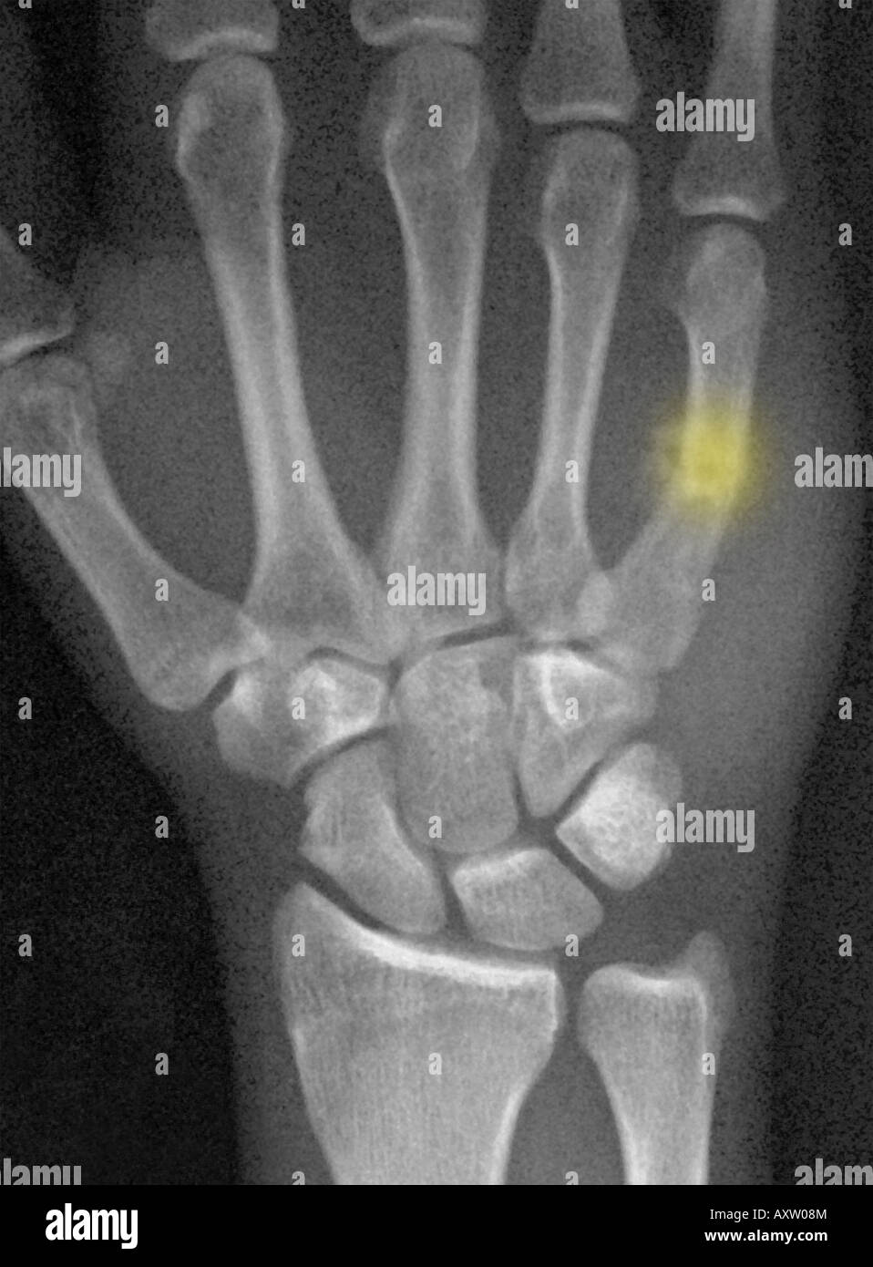 xray of the hand of a man showing a healing boxer's fracture, a break