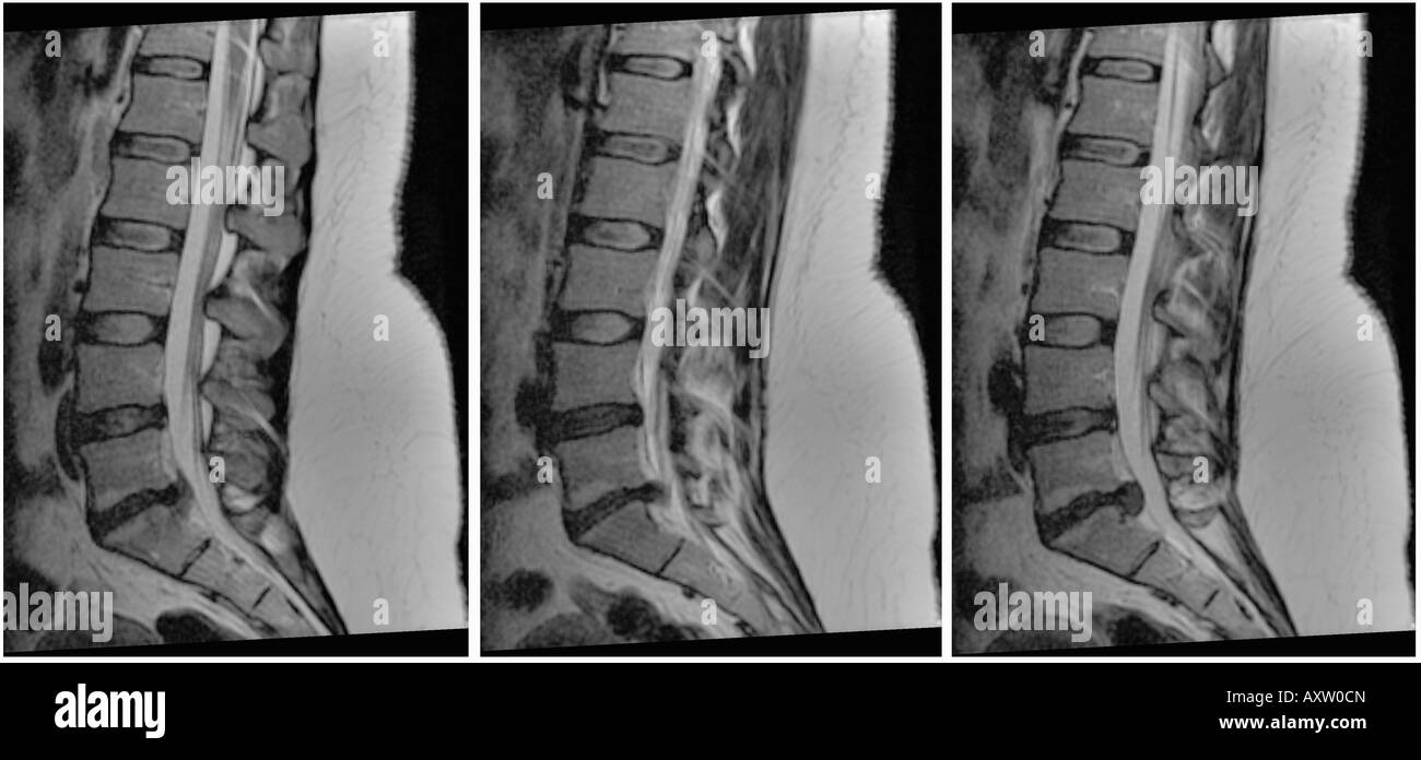 MRI of the spine on a 29 year old female who developed back pain after bending.  The MRI scan shows herniated, bulging disks Stock Photo
