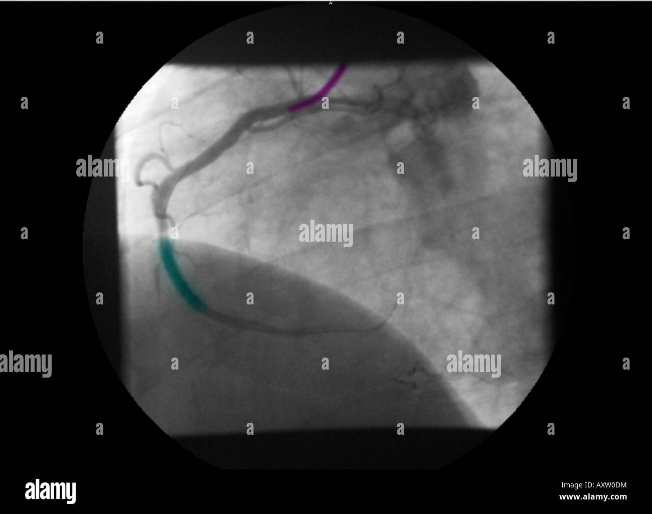 digitally-enhanced, colorized x-ray of a coronary angiogram showing a stent to correct the stenosis of the right coronary artery Stock Photo