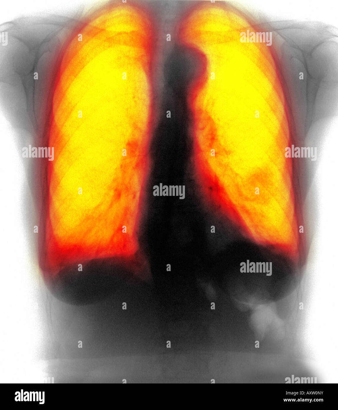 COPD Chest X Ray