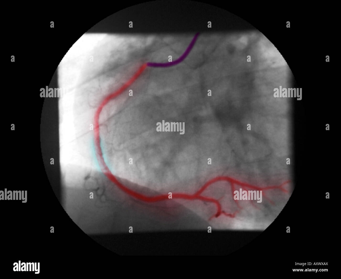 digitally-enhanced, colorized x-ray of a coronary angiogram showing a stent to open up the stenosis of the right coronary artery Stock Photo
