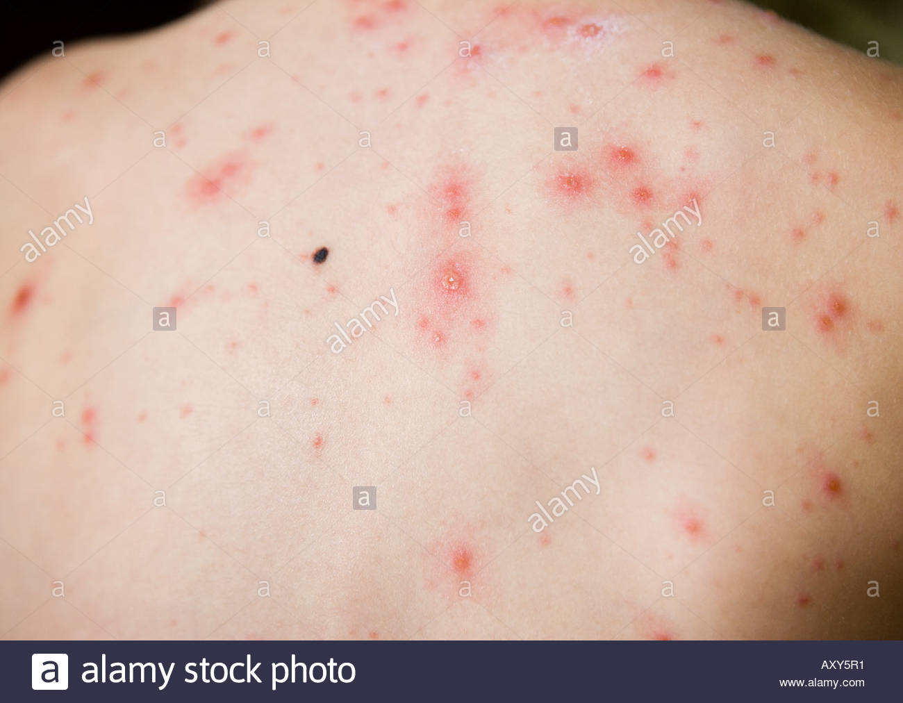 Chicken Pox Stock Photos & Chicken Pox Stock Images - Alamy