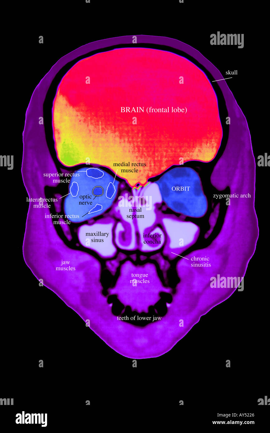 CT scan of the head of a 35 year old woman showing a coronal maxillofacial view of the normal anatomy labelled Stock Photo