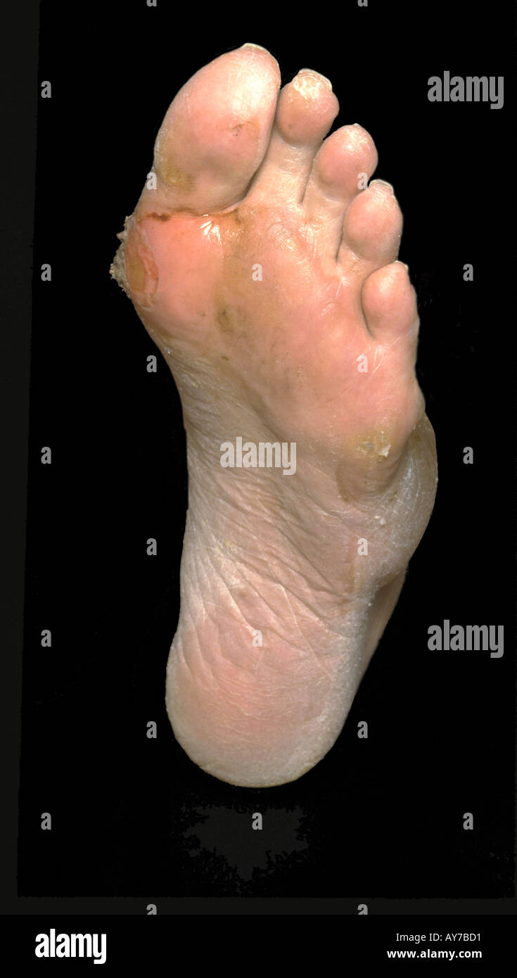 Blisters on feet hires stock photography and images Alamy