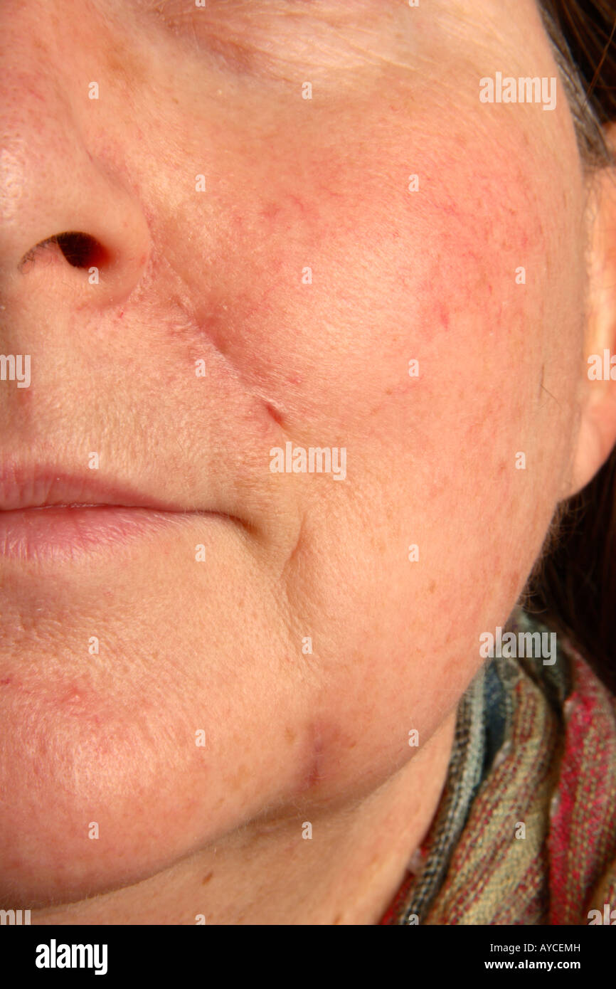 Healing Scars On Face