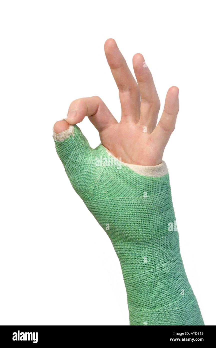 Arm cast hi-res stock photography and images - Alamy