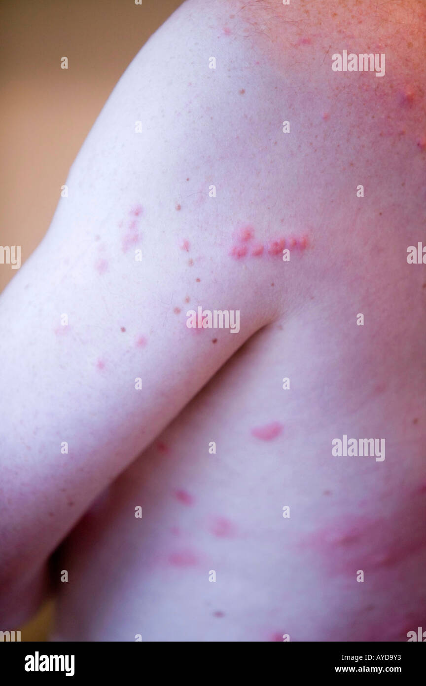 Midge bite hires stock photography and images Alamy