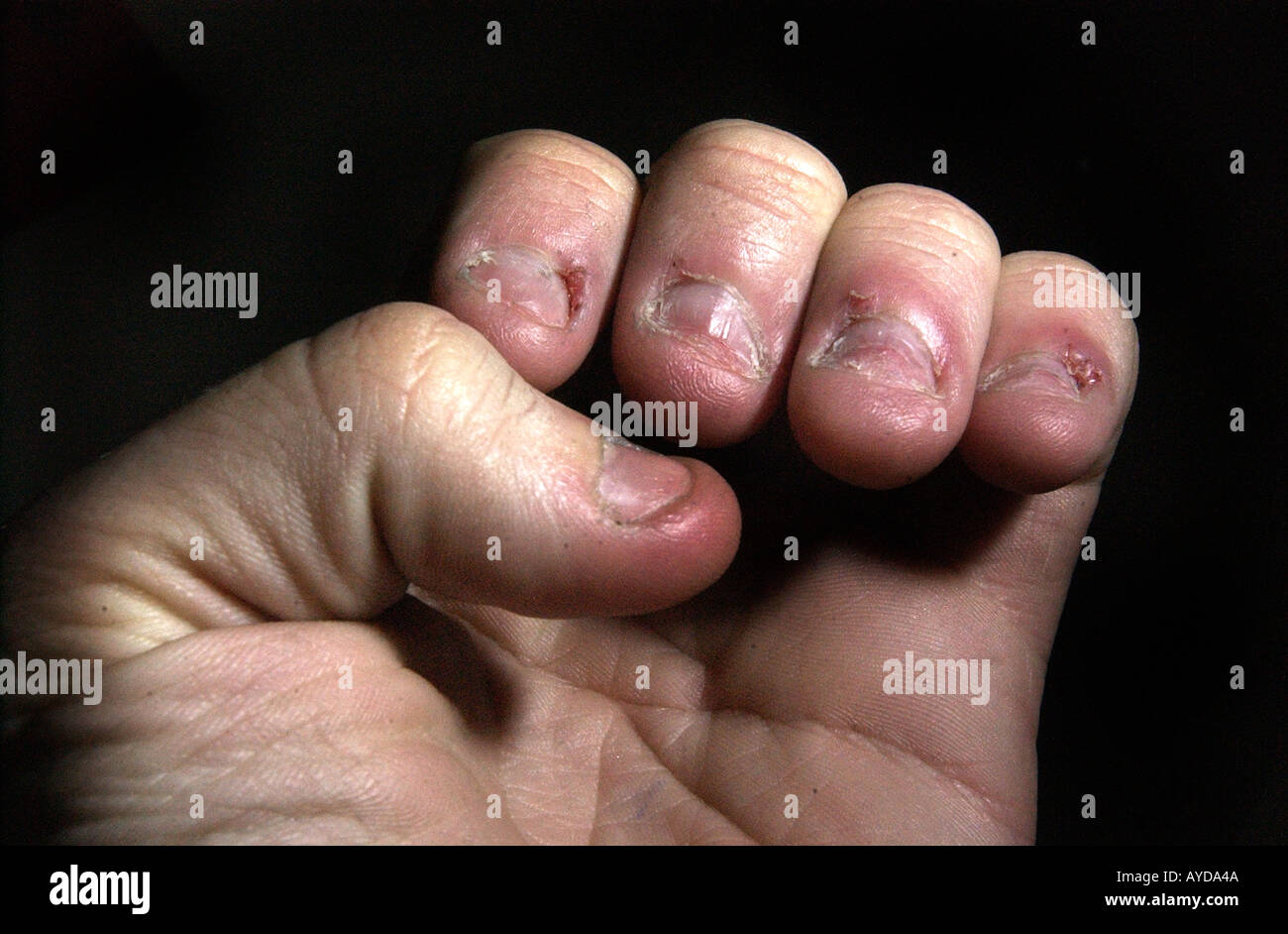 Nail nailbiting hires stock photography and images Alamy