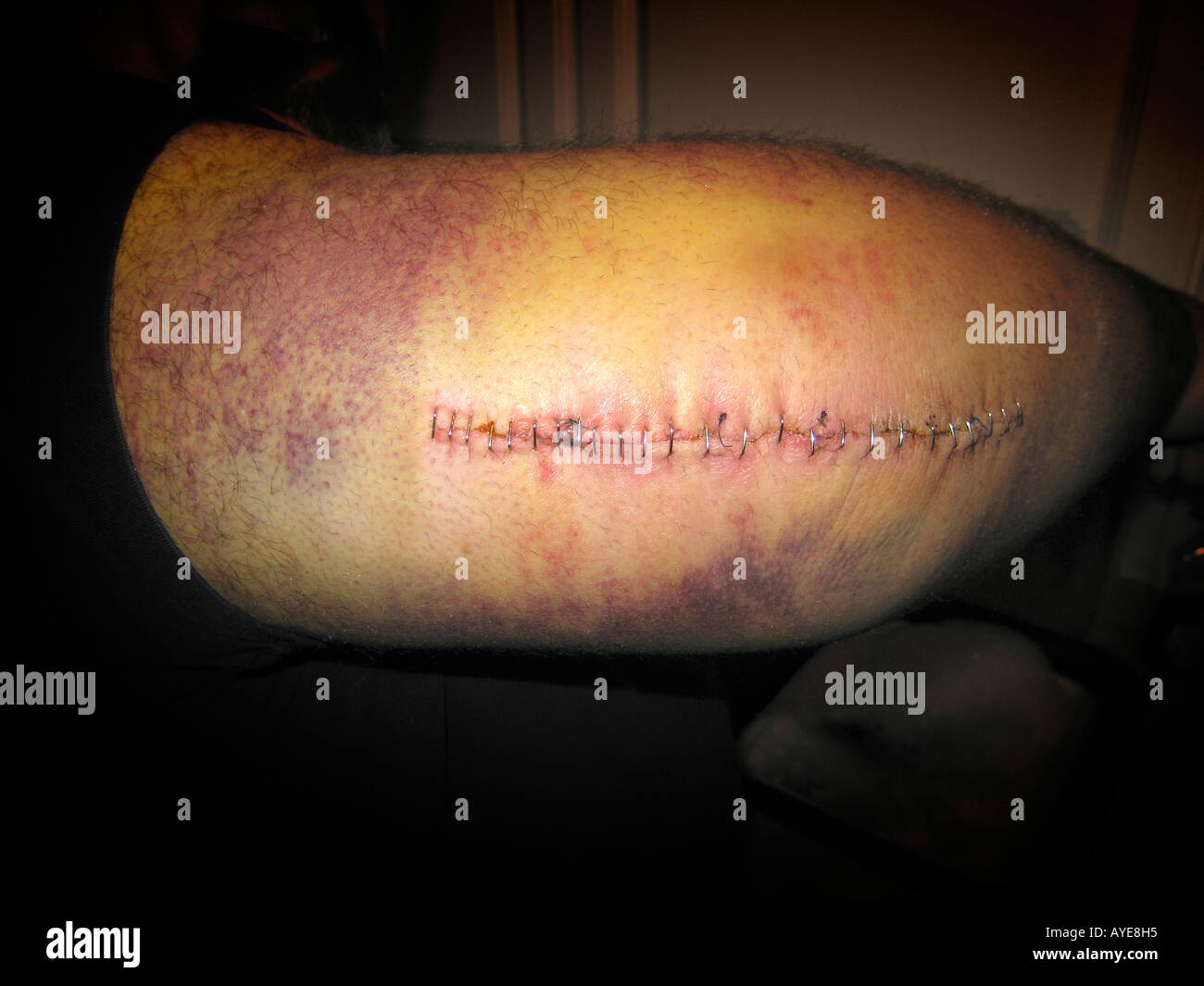 Large scar with staples on mans arm Stock Photo