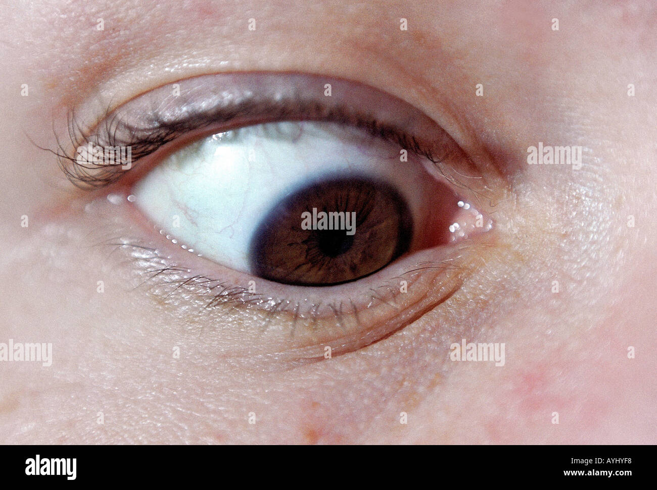 Schielendes Auge mit brauner Pupille Stock Photo