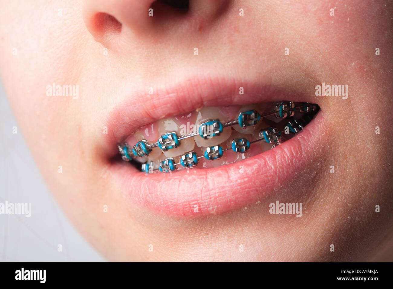 teeth brace blue bands metal lips skin dental ortho orthodontic repair