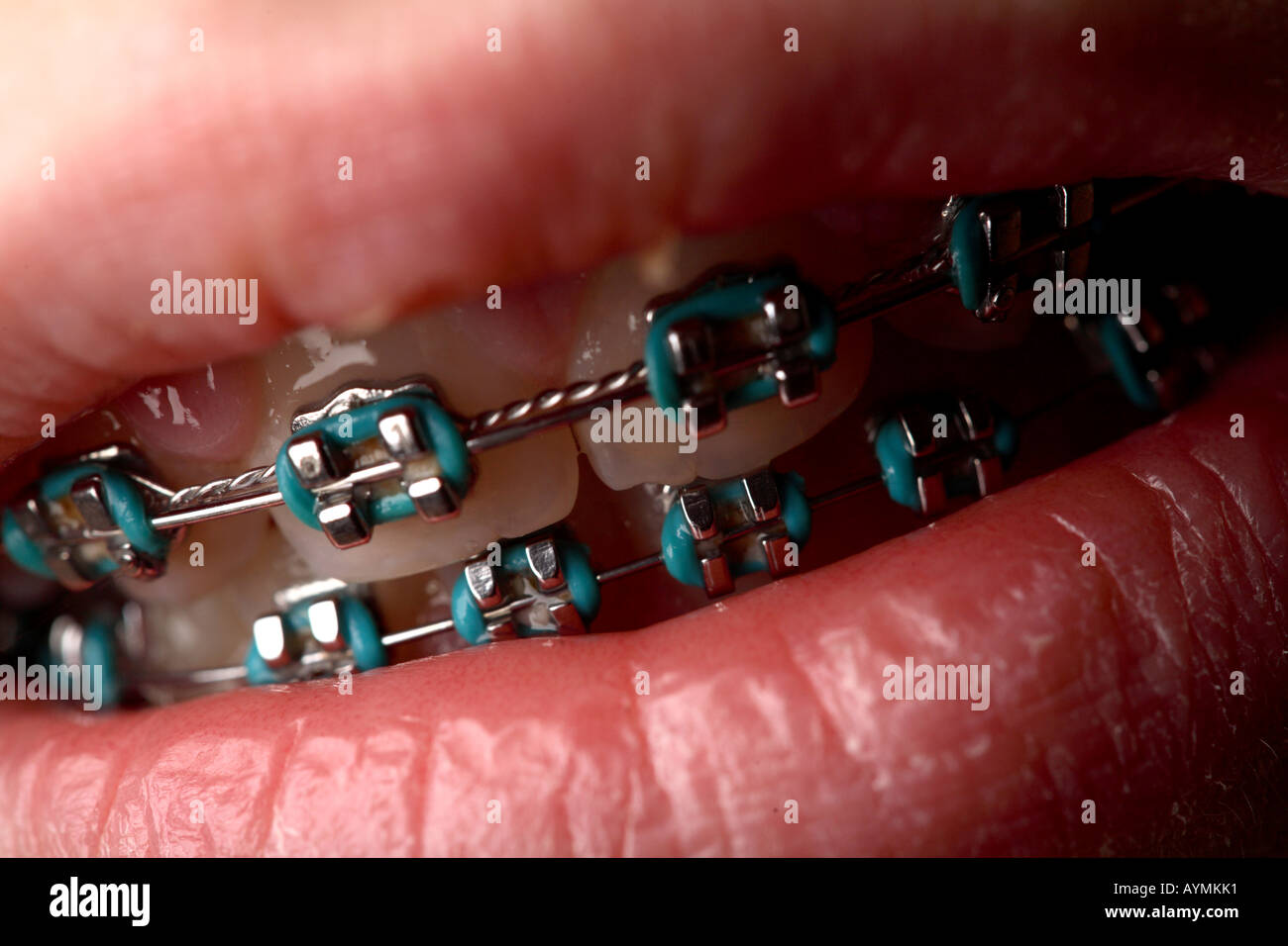 teeth brace blue bands metal lips skin dental ortho orthodontic repair