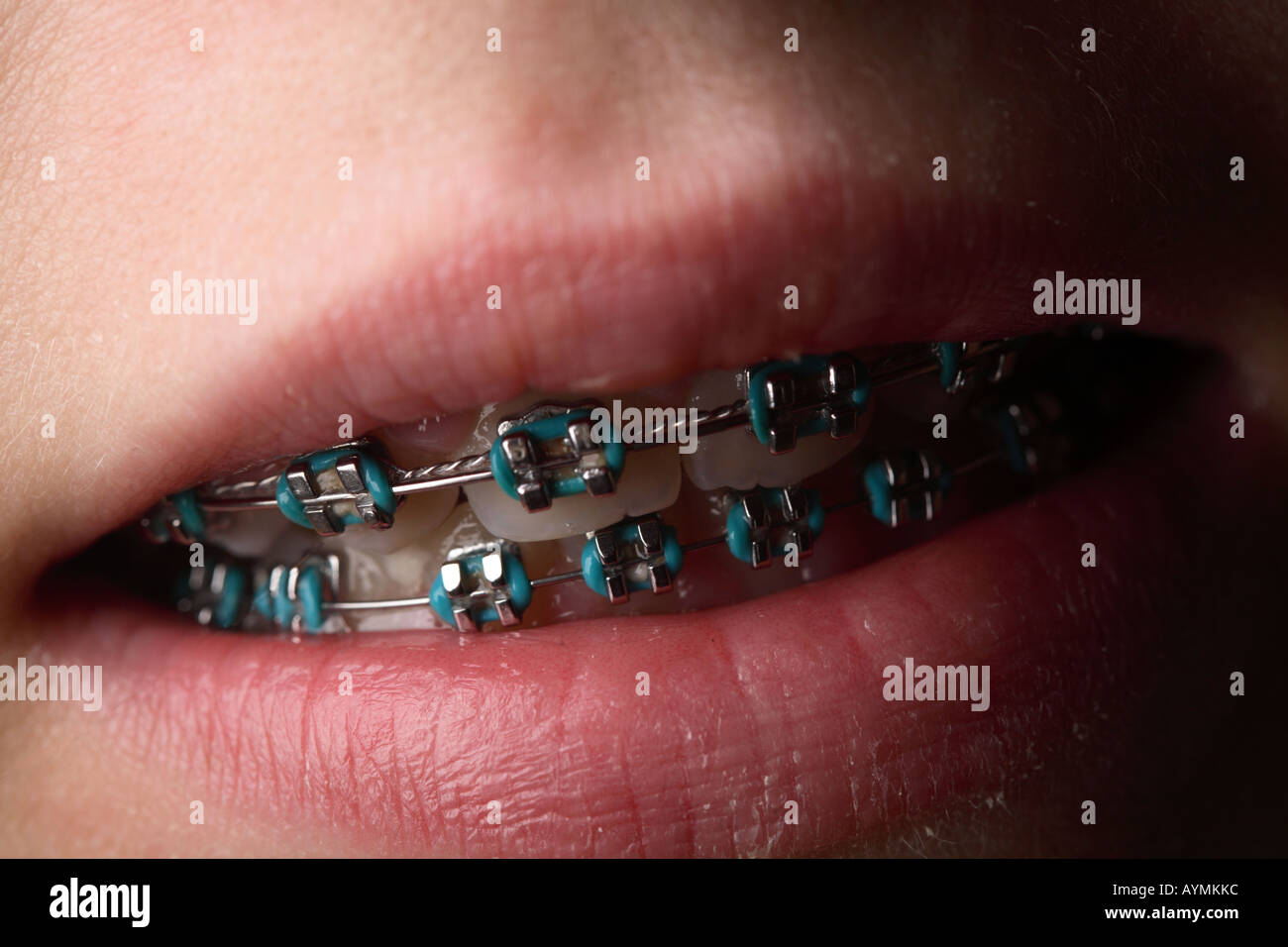 teeth brace blue bands metal lips skin dental ortho orthodontic Stock