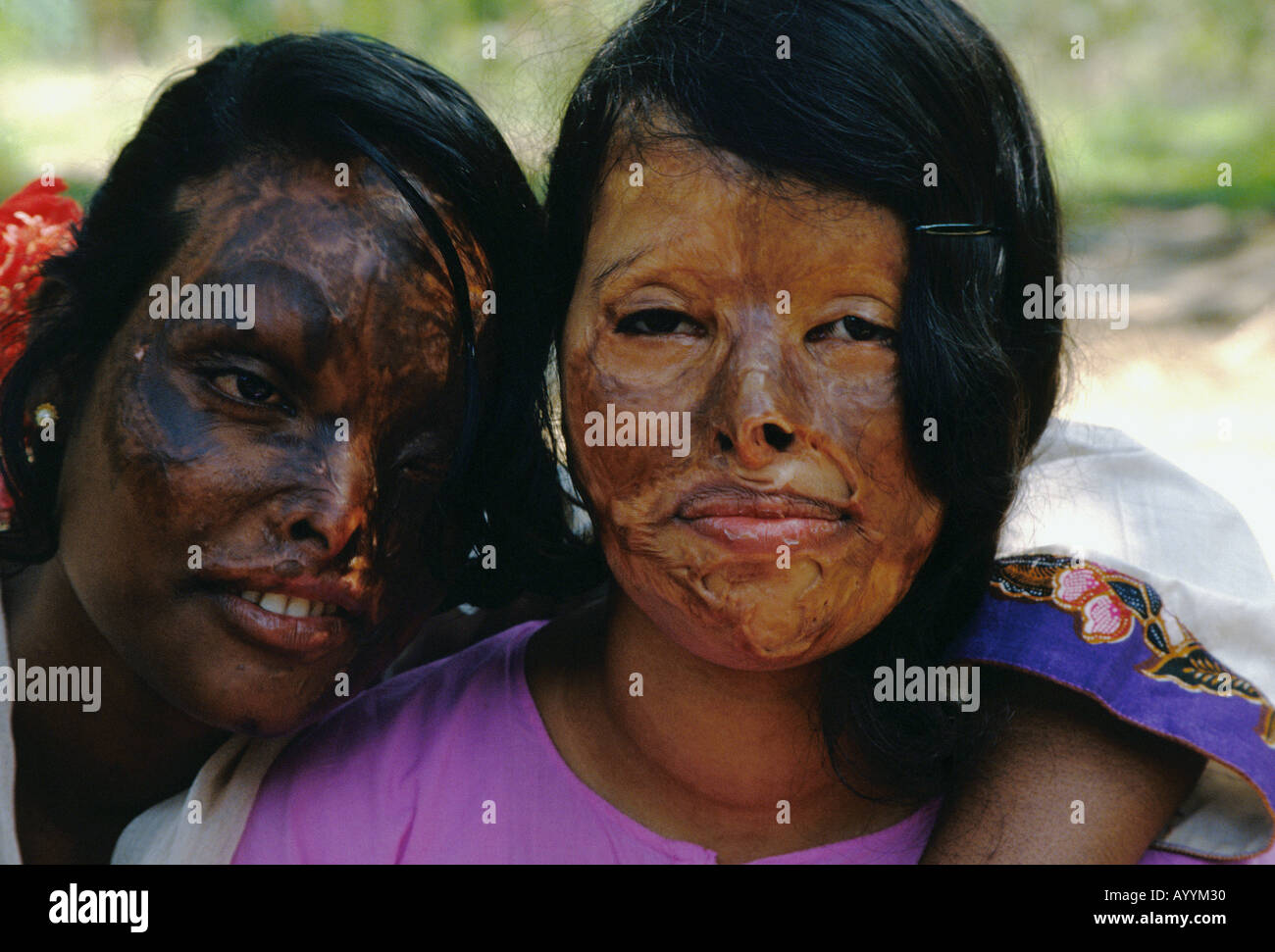 Bangladesh, acid attack survivors Stock Photo