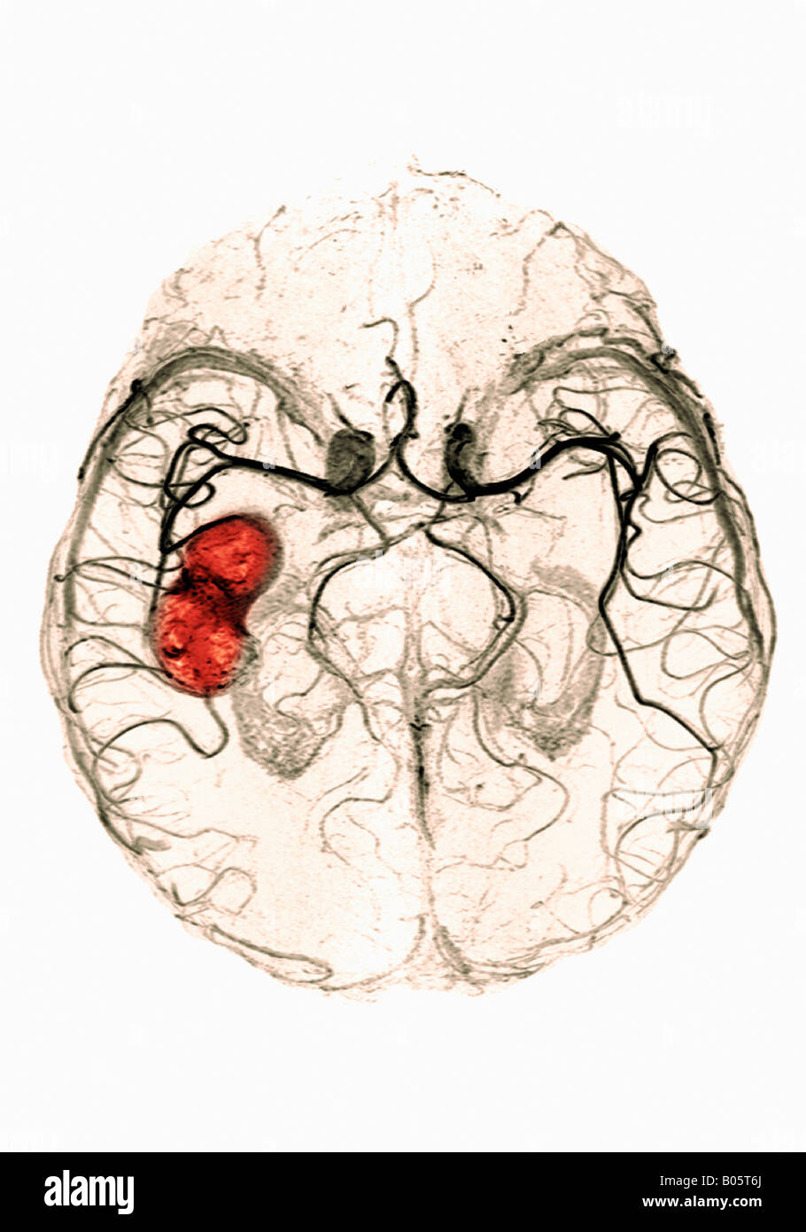 Blood Clot Brain High Resolution Stock Photography and Images Alamy