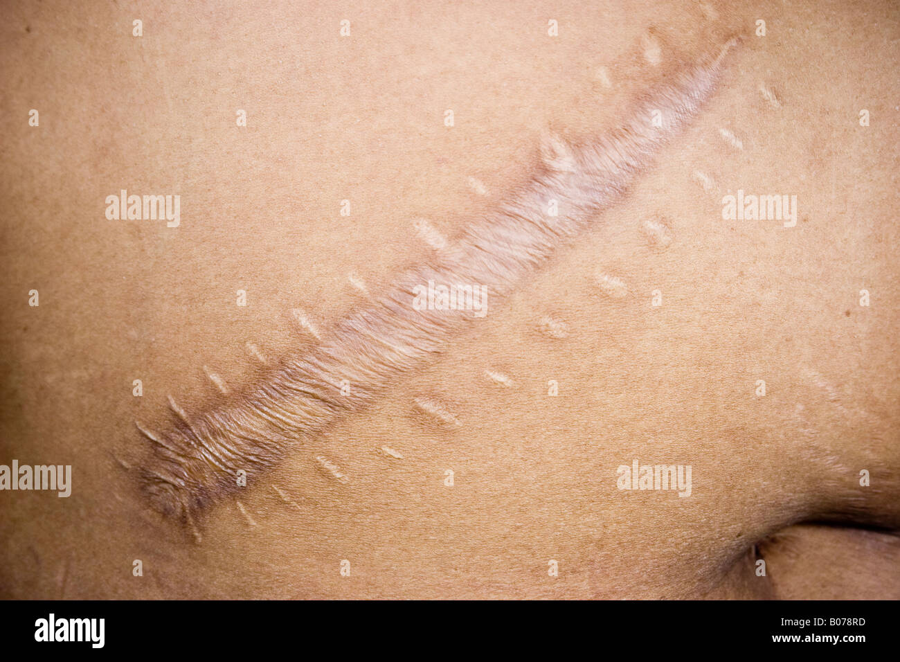Knife wound surgery scar Stock Photo