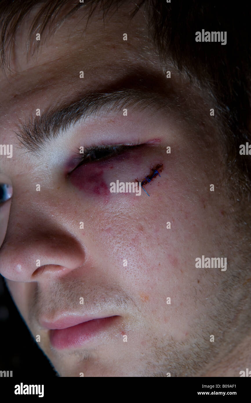 Young teenager with black and bruised stitched eye Stock Photo