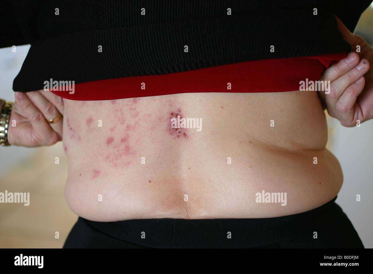 Shingles woman hi-res stock photography and images - Alamy