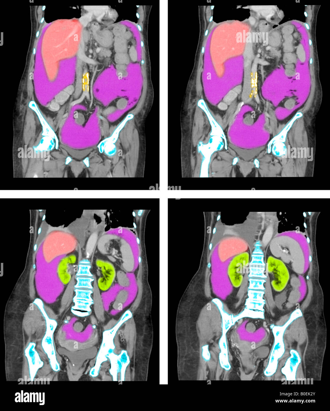Why Ct Scan Abdomen Pelvis