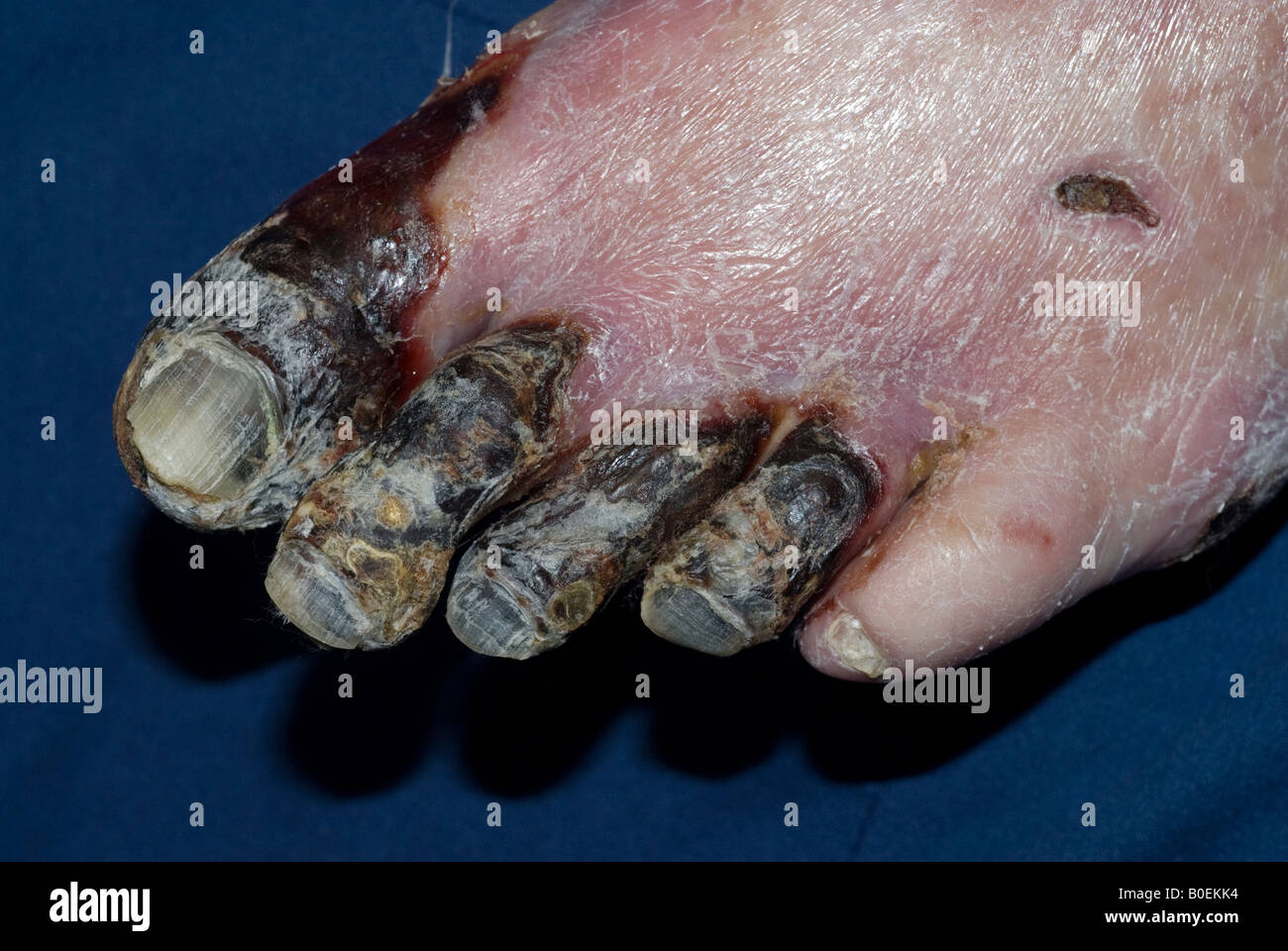 77 year old diabetic male with a gangrenous foot from poor circulation Stock Photo