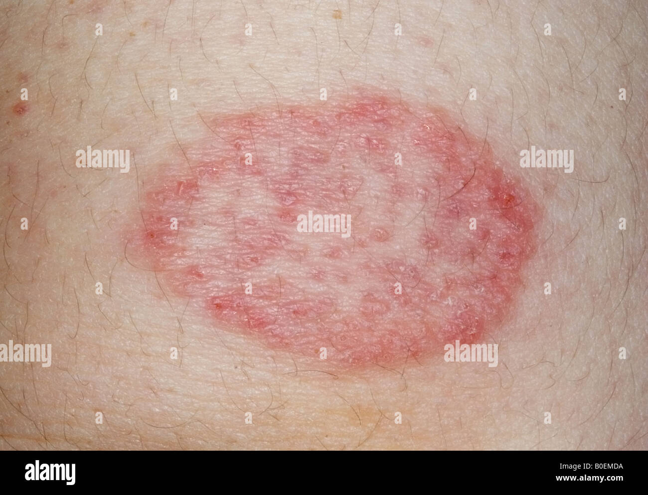 ringworm fungus infection of the skin Stock Photo