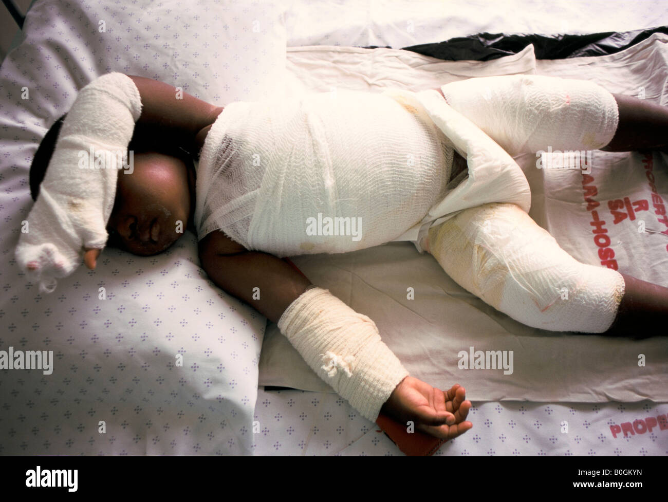 A child wrapped in bandages at a burns unit in Baragwanath Hospital, Soweto, South Africa Stock