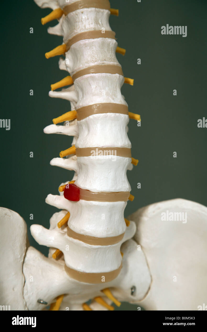 A model of a lumbar spine showing a damaged intervertebral disc Stock Photo