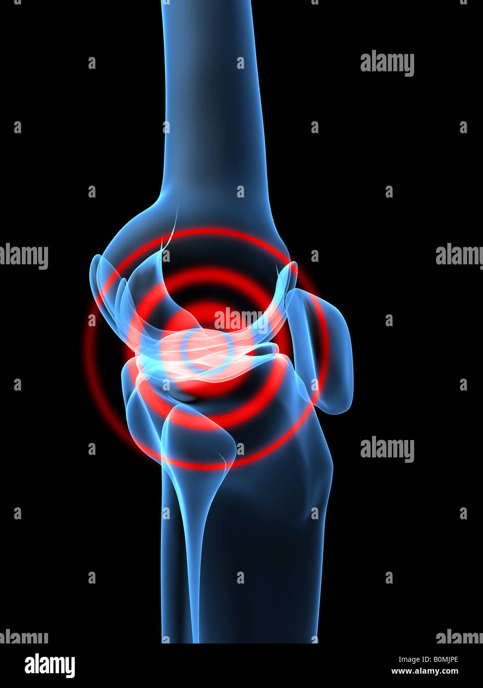 Cartilage and inflammation and knee hires stock photography and images