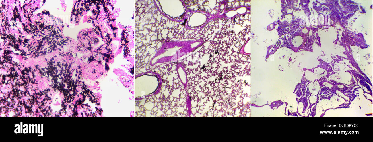 lung composit Stock Photo