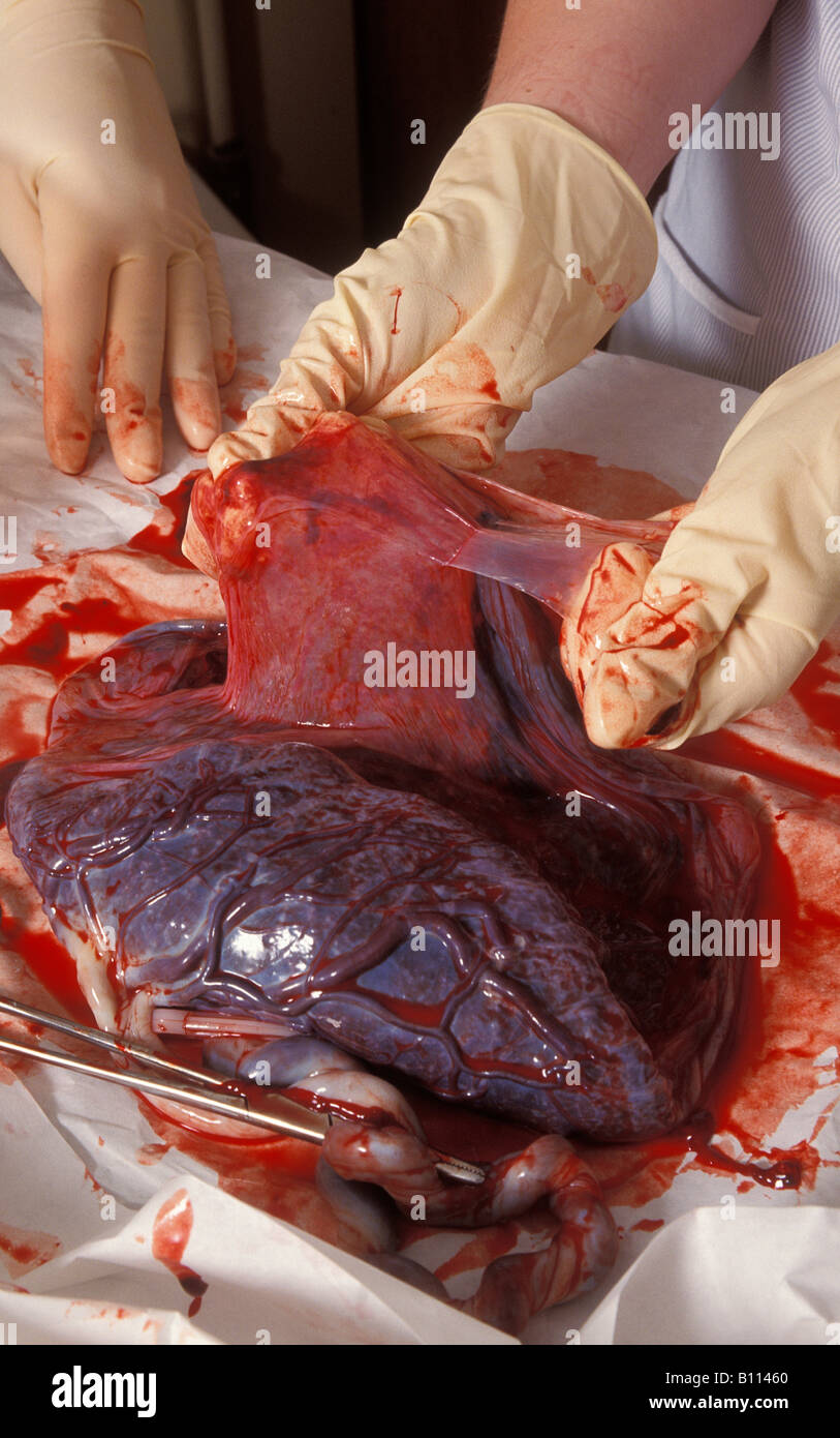 young student midwife examining placenta straight after birth Stock Photo