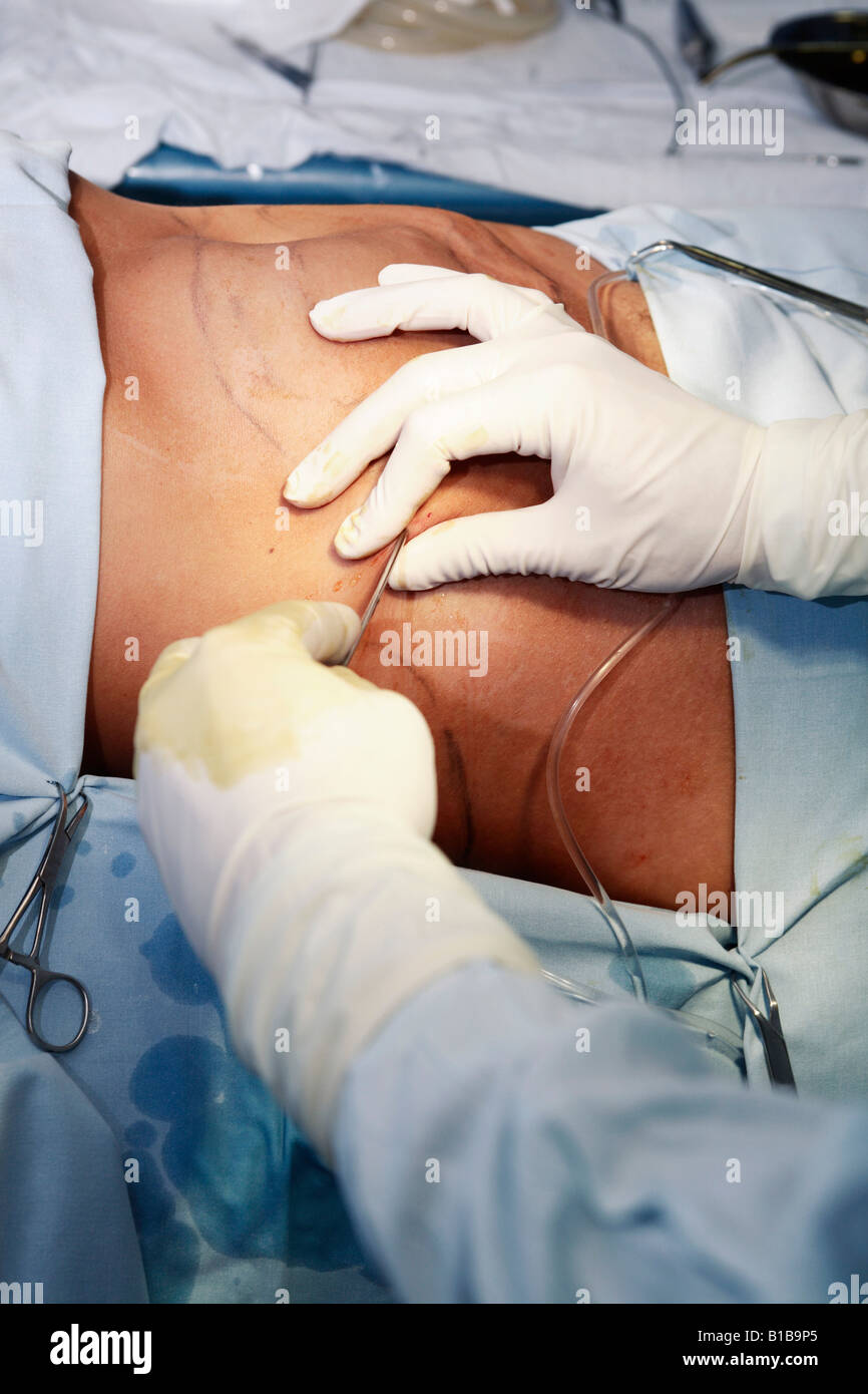 Surgeon performing fat loss surgery Stock Photo