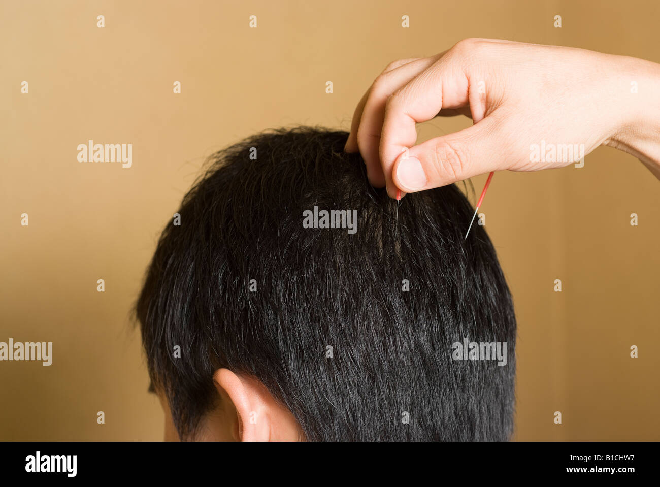 Doctor putting acupuncture needles on patient's head Stock Photo Alamy