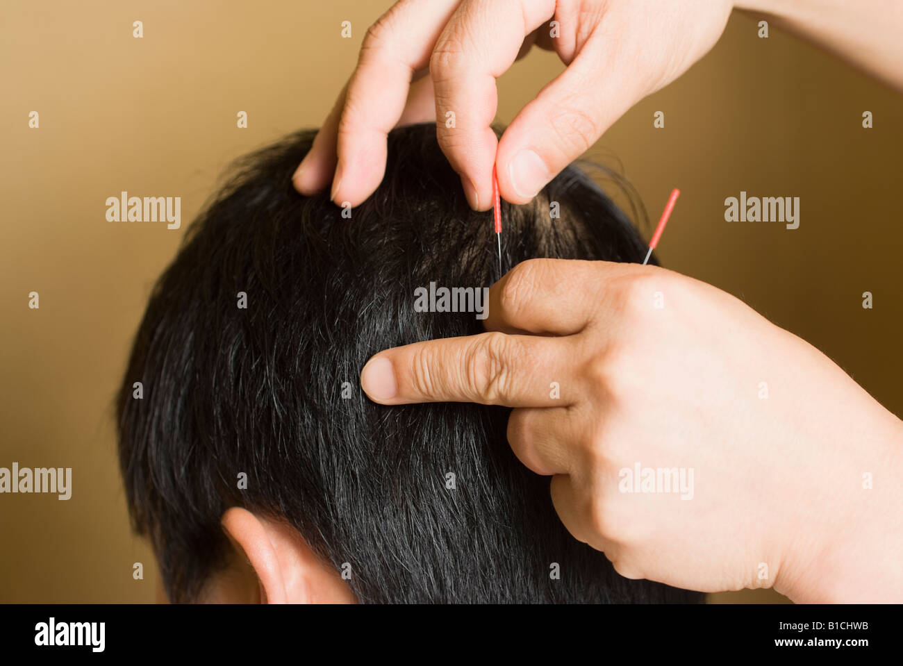 Doctor putting acupuncture needles on patient's head Stock Photo Alamy