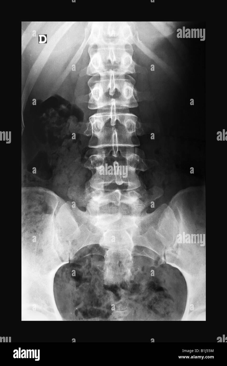 X-ray of the spinal column and pelvis of a woman Stock Photo - Alamy