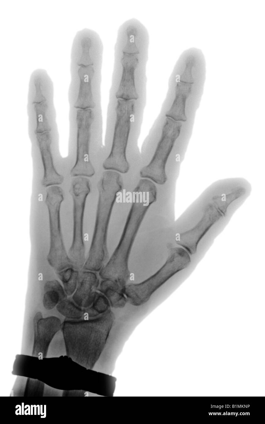 X-ray of 77 year old woman's hand with osteoporosis Stock Photo