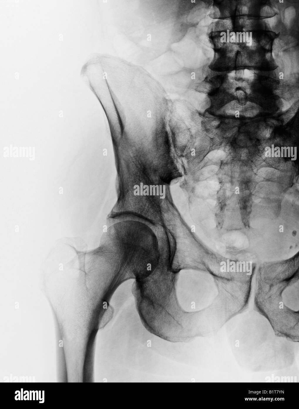 X-ray of 51 year old male's hip Stock Photo