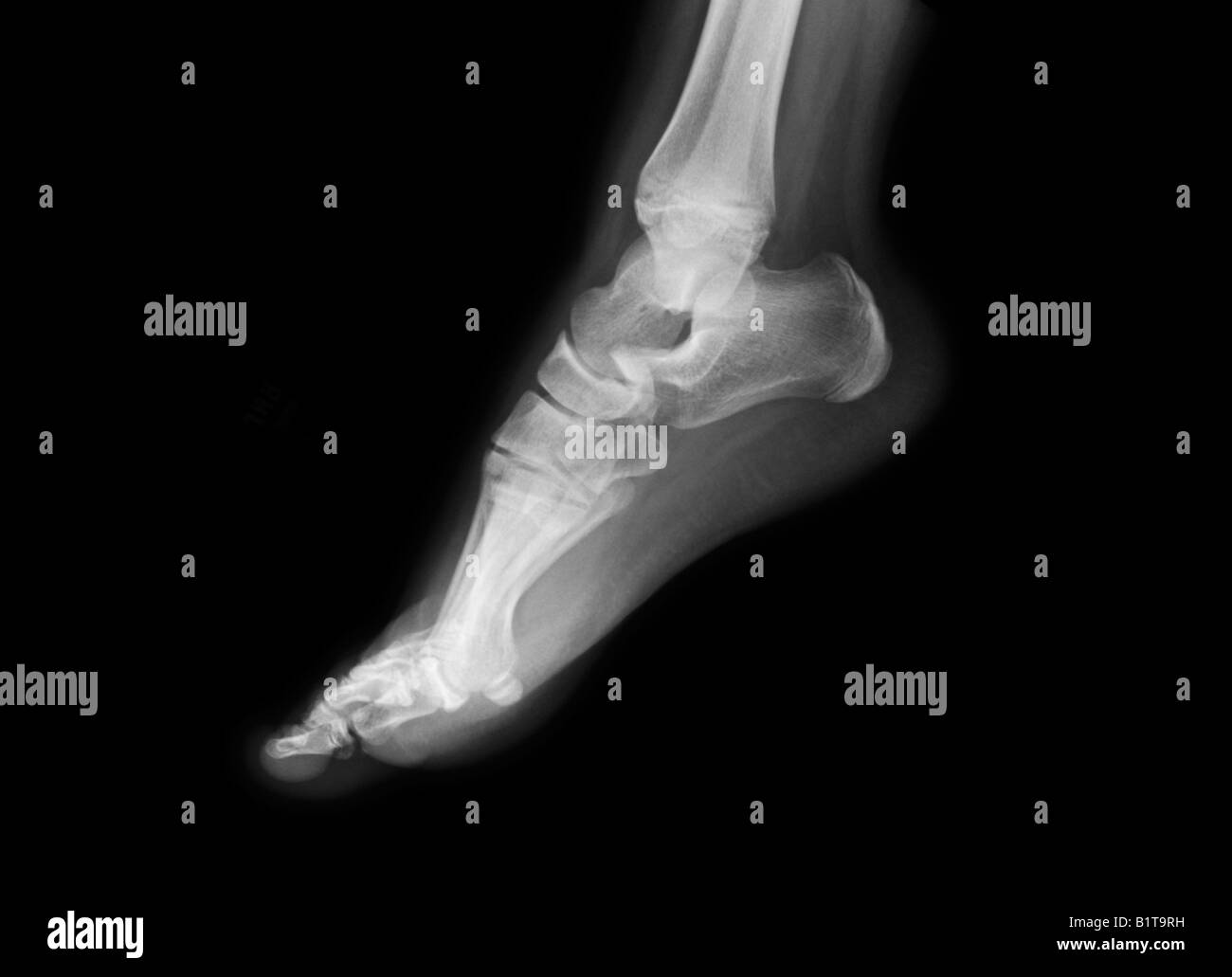 Xray of 11 year old female's foot Stock Photo Alamy