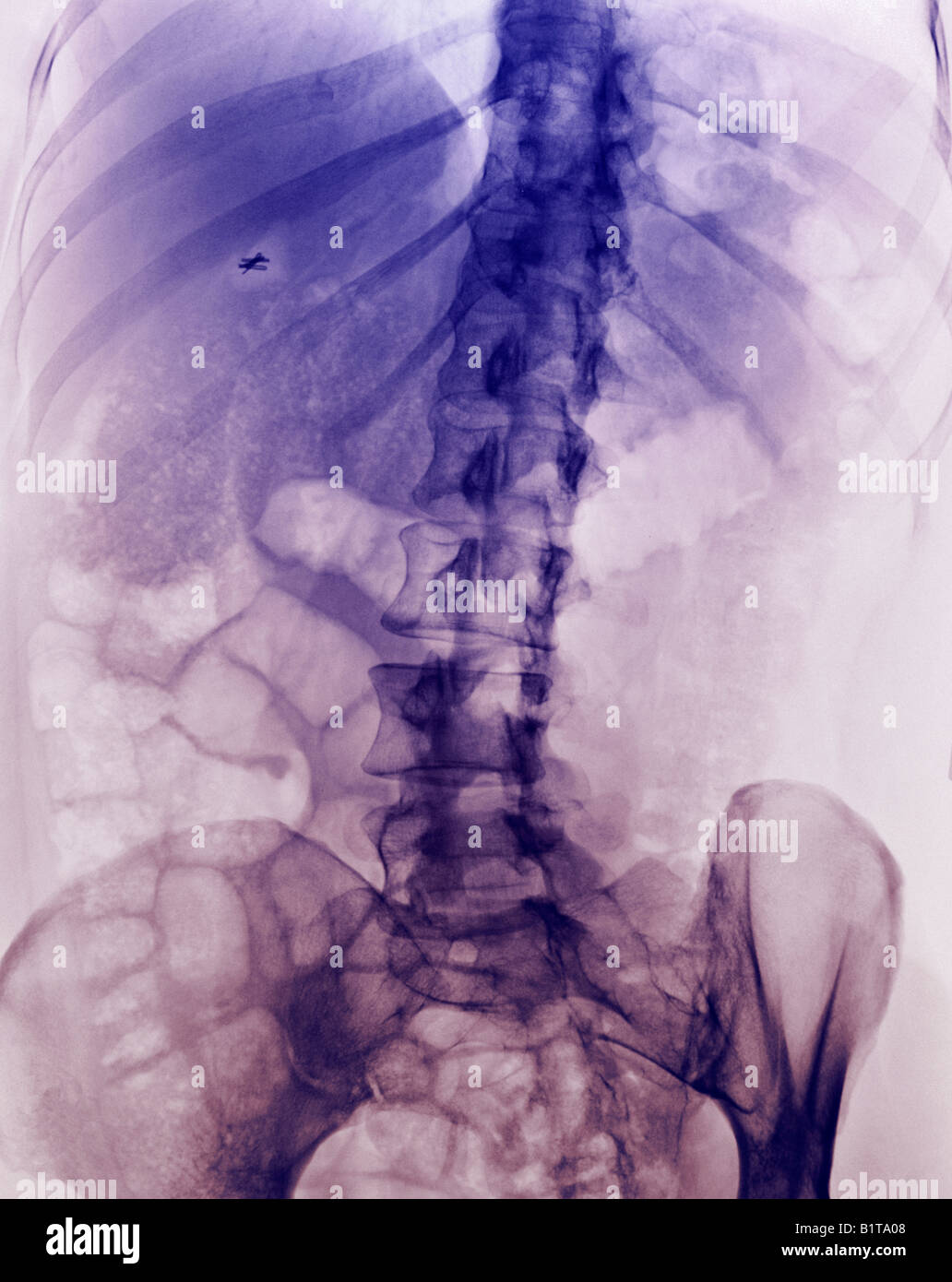 X ray normal lumbar spine hires stock photography and images Alamy