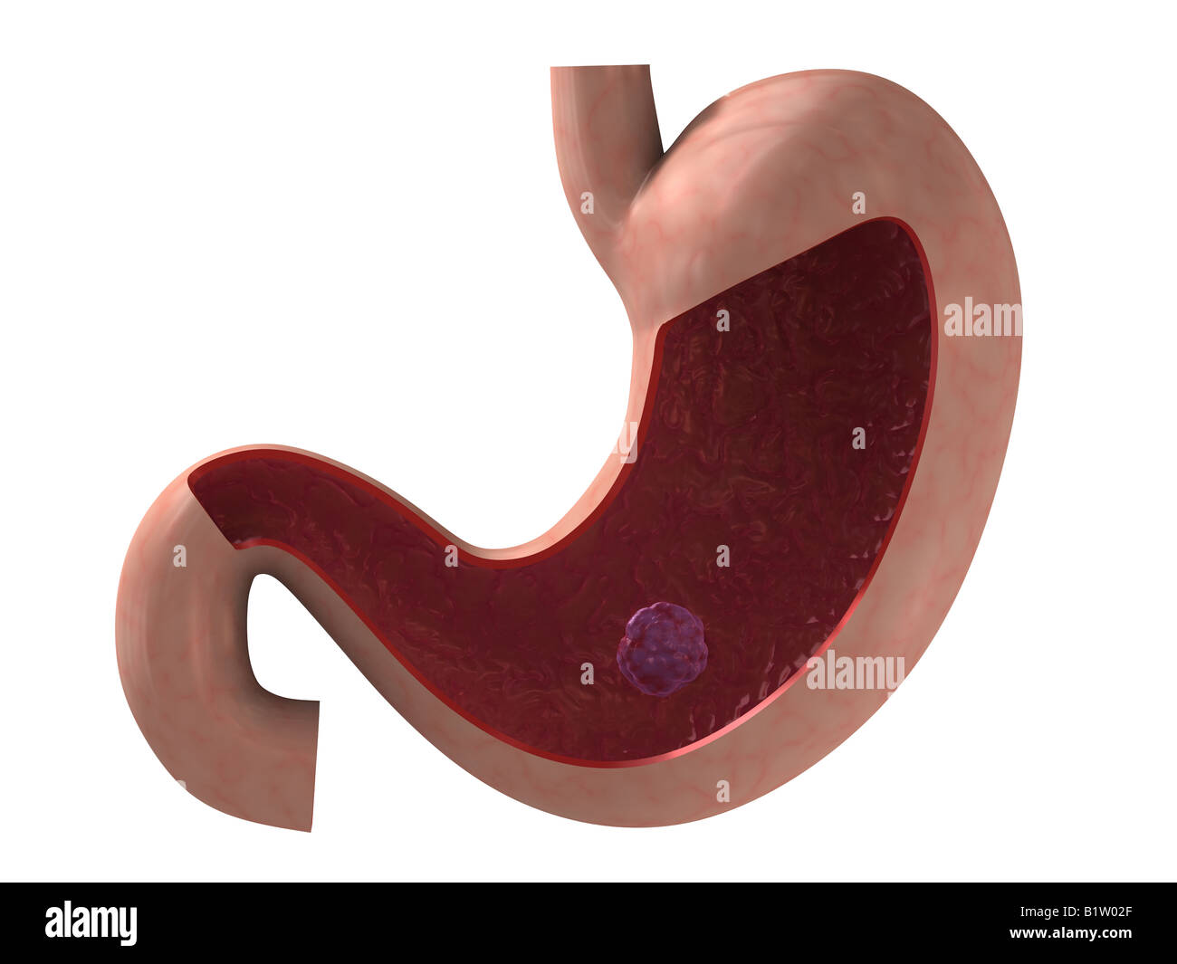stomach ulcer Stock Photo