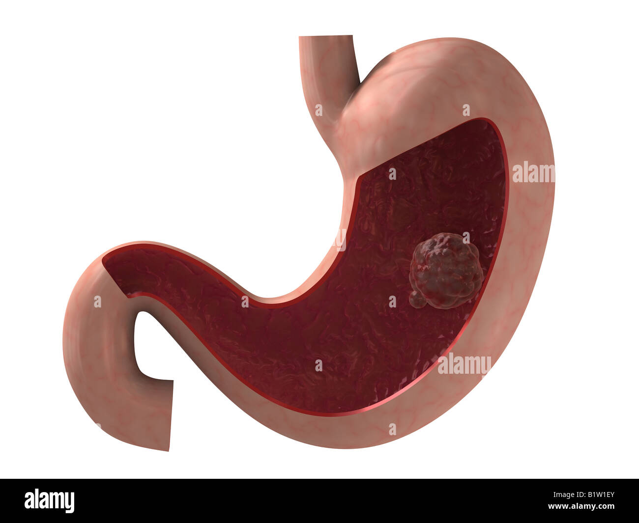 stomach cancer Stock Photo