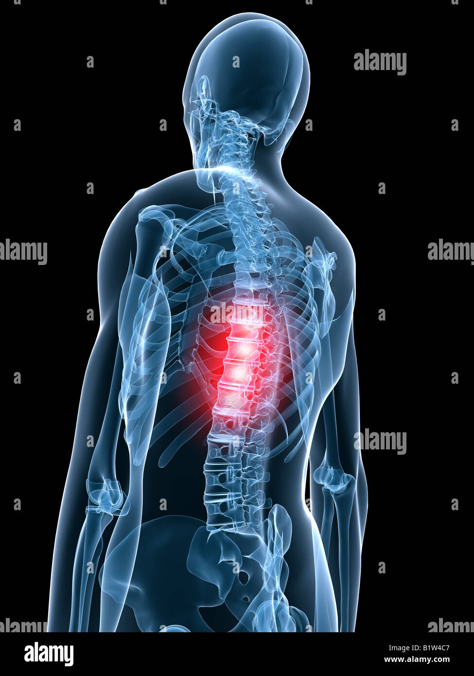 Arthritis Of The Spine High Resolution Stock Photography and Images Alamy